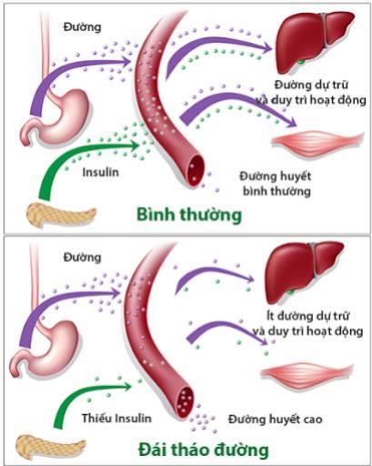 H­ướng dẫn chẩn đoán và điều trị đái tháo đường type 2