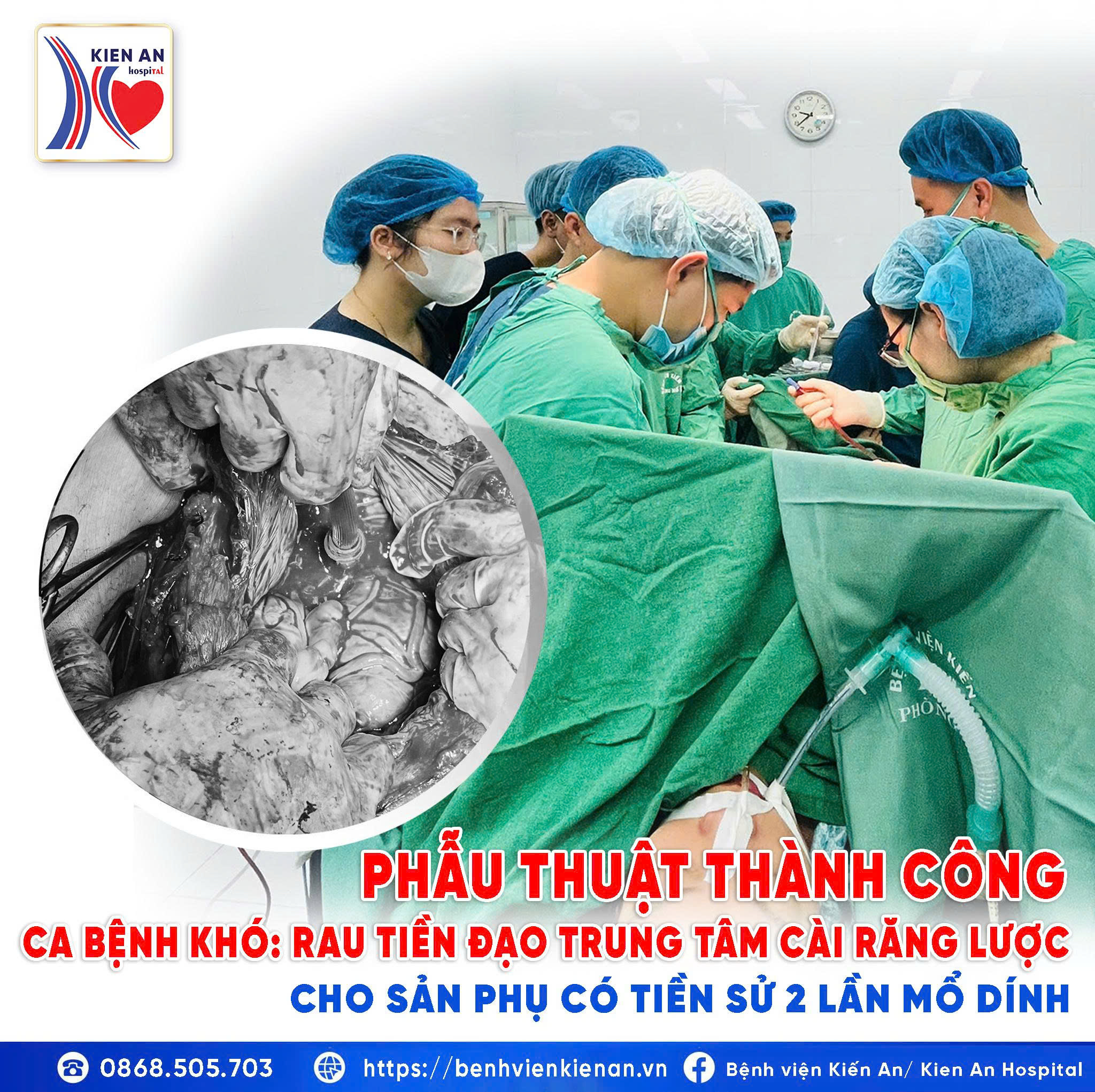 PHẪU THUẬT THÀNH CÔNG CA RAU TIỀN ĐẠO CÀI RĂNG LƯỢC NGUY CƠ CAO
